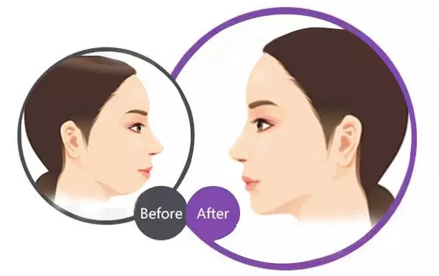 玻尿酸和瘦脸针一起打,会有什么副作用吗?_云