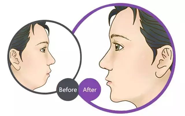 玻尿酸和瘦脸针一起打,会有什么副作用吗?_云