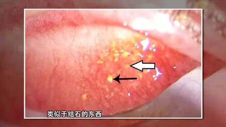 眼结石.jpg