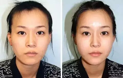 【全脸自体脂肪填充】纳米脂肪填充,存活率达