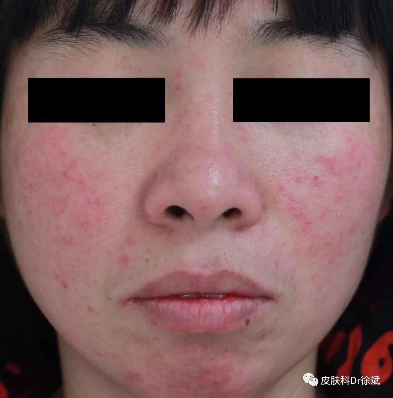 面部反复潮红过敏,需警惕玫瑰痤疮