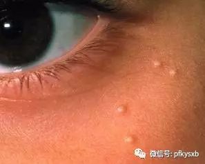 长在眼睛周围的小颗粒之三粟丘疹
