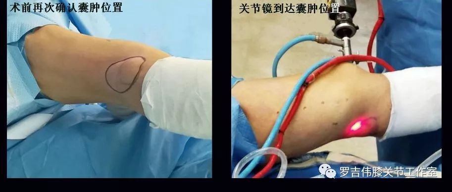 膕窝囊肿切除术拆一面墙or开一扇窗