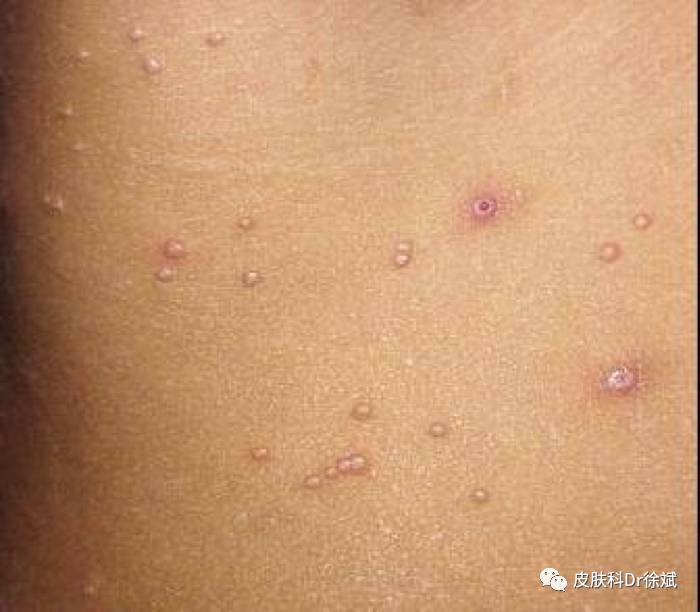 戏水虽爽,但需当心传染性软疣(儿童皮肤病科普