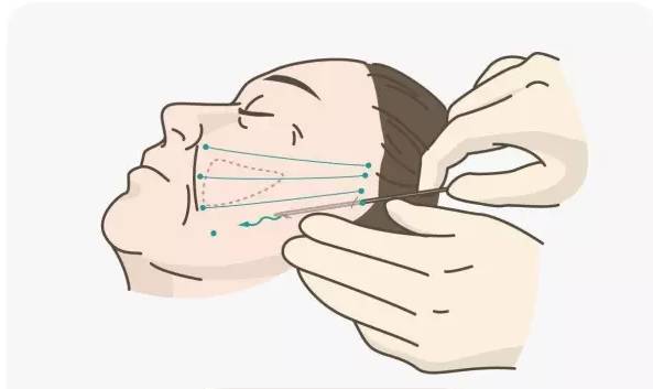 法令纹治疗方法|法令纹分3型,你是哪一型?_云