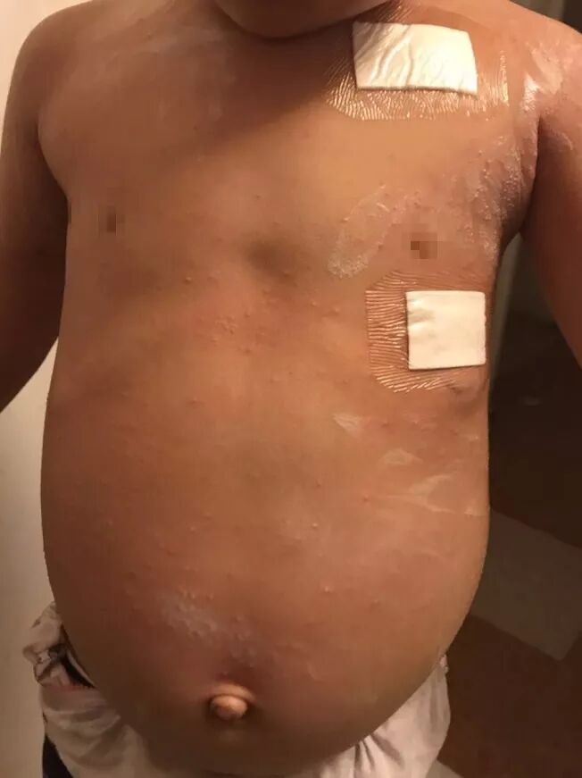 庸医！华人儿科失职 4岁华裔女童肾癌末期！其母控诉 错过最佳治疗时间... - 1