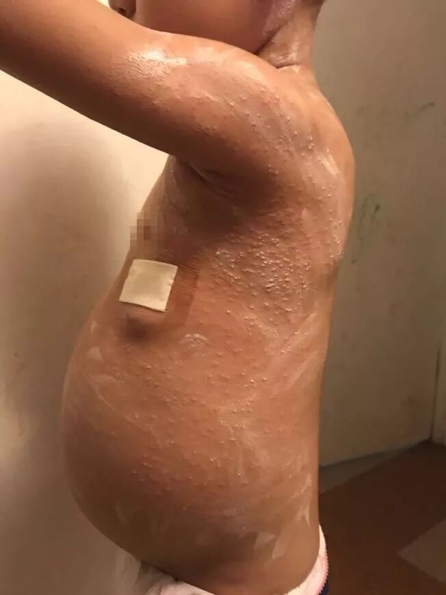 庸医！华人儿科失职 4岁华裔女童肾癌末期！其母控诉 错过最佳治疗时间... - 2