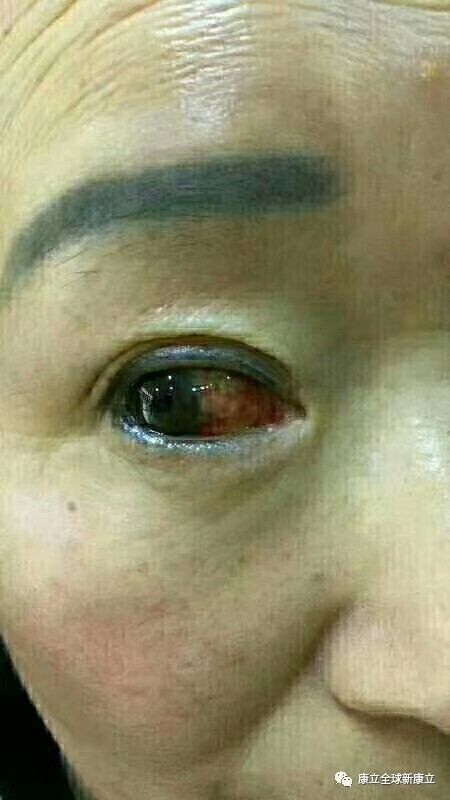 康立康医视负离子眼镜~ 病例反馈_康立负离子眼镜_新康立健康产业有限公司 康立康医视负离子眼镜~ 病例反馈_康立负离子眼镜_2017-10-1 15:31