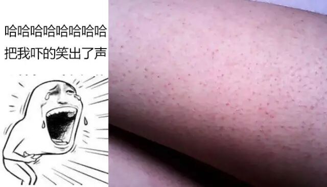 遗传性的鸡皮肤怎么袪(遗传性的鸡皮肤能根治吗)