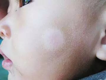 孩子脸上的白斑是蛔虫引起的吗? - 好大夫在线