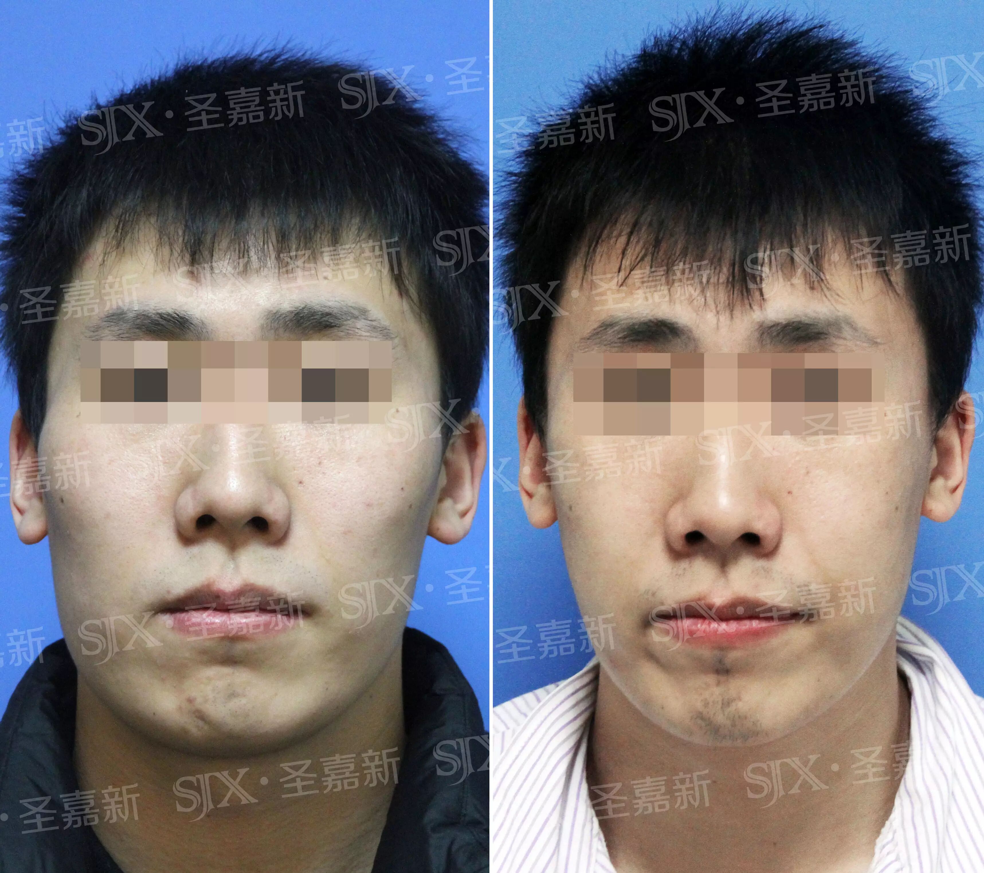 整形不再是女人的专利男人也可以