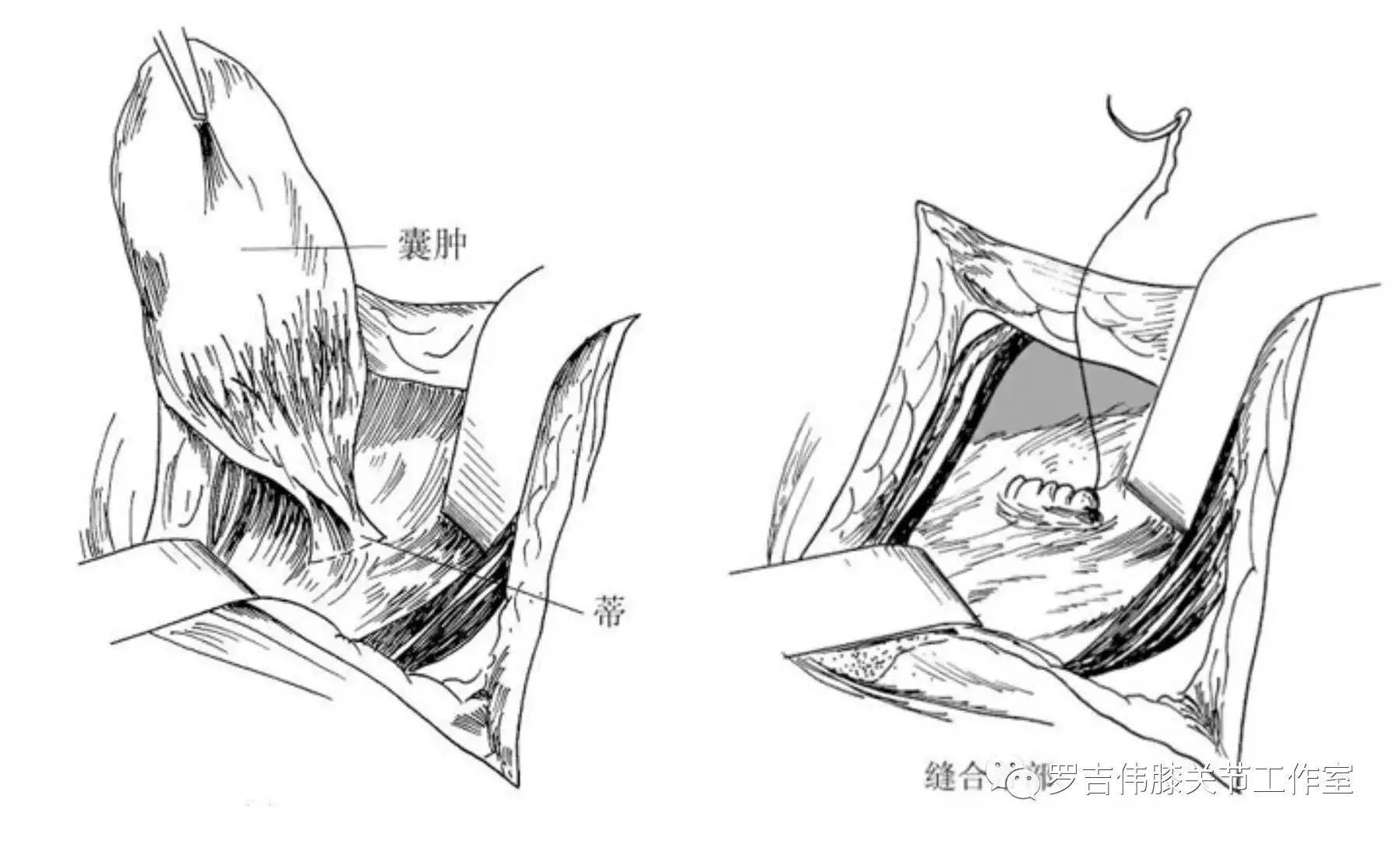 膕窩囊腫切除術拆一面牆or開一扇窗