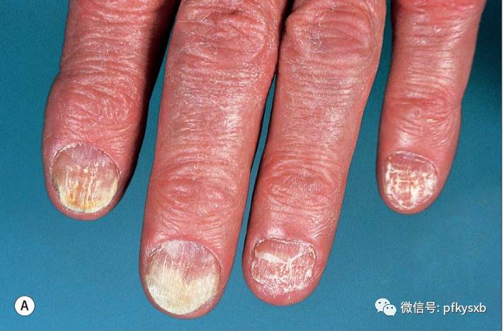 能不能治好?_灰指甲_疾病介绍_治疗方法_介绍_治疗方式 - 好大夫在线
