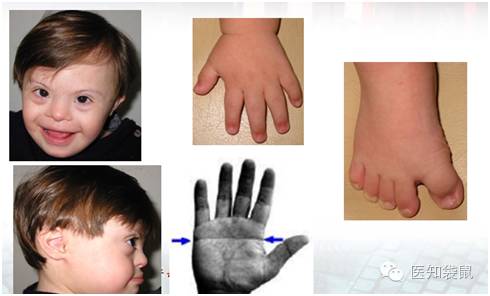 唐氏筛查产检时医生没告诉你的