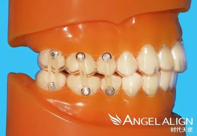 小身材大作用牙套上橡皮筋的n个秘密