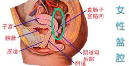 你所不知道的"盆腔积液"!还不进来看看? - 盆腔炎 - 好孕帮